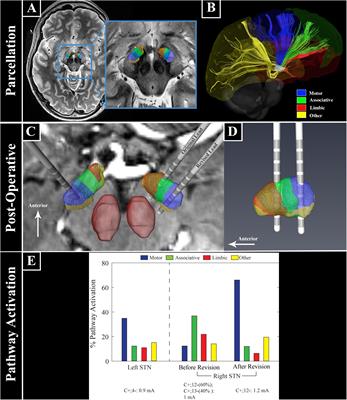 7T MRI and Computational Modeling Supports a Critical Role of Lead Location in Determining Outcomes for Deep Brain Stimulation: A Case Report